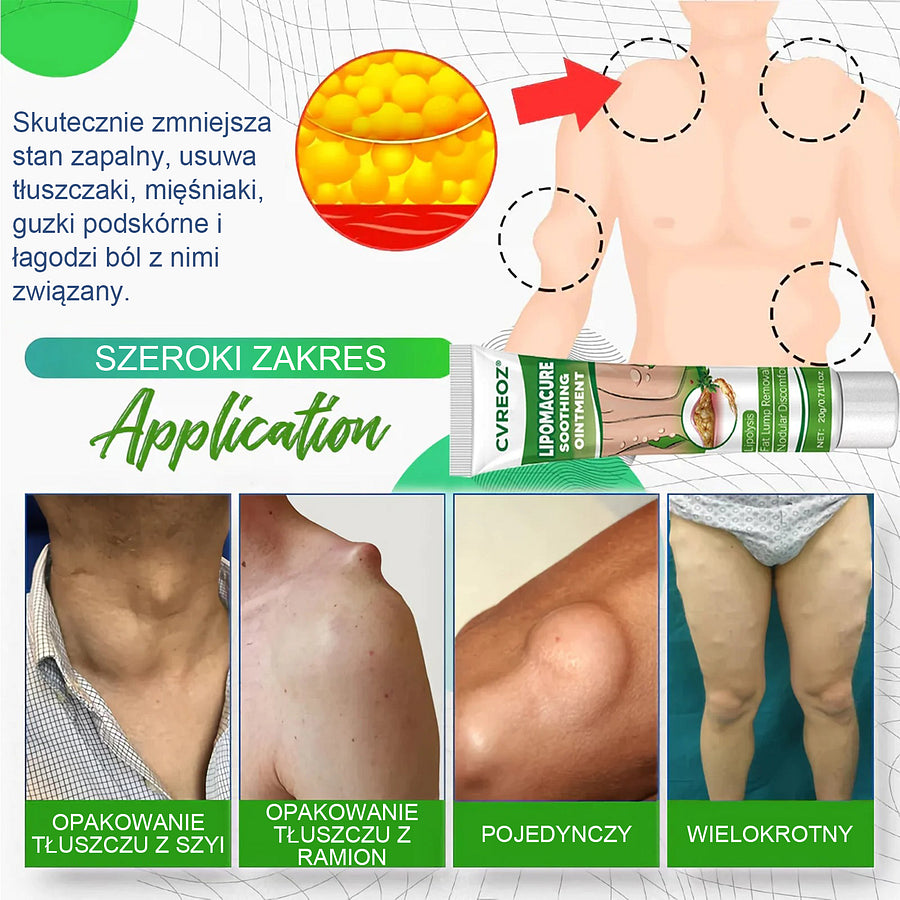 Cvreoz® Soothing Ointment behandelt Lipome problemlos und erzielt innerhalb von 2 Wochen eine deutliche Verbesserung