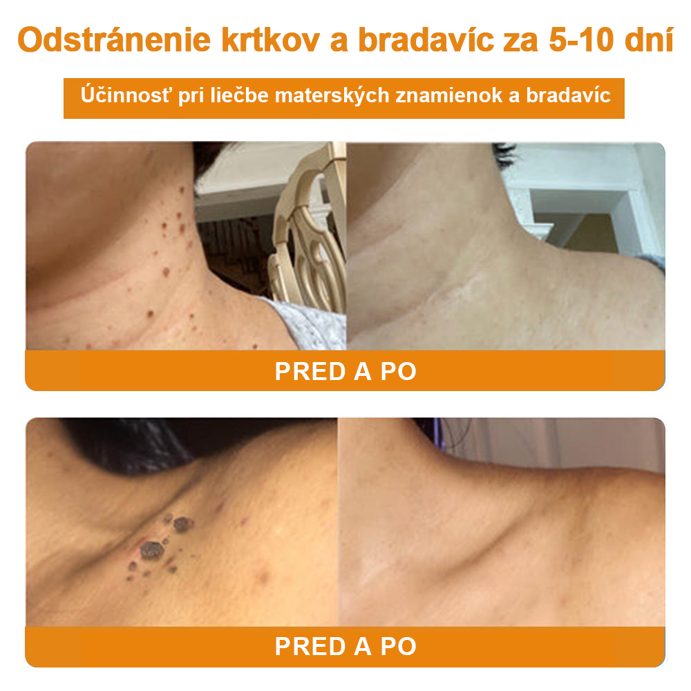 🧄𝑉𝑠𝑜𝑥𝑎™Velim Jędom Odsłanenij Bradavič Krém Znamionok (🧑⚕️AAD odporúča)🐝🐝(🔥Akcia na posledný deň - 80% zľava💒)🥔