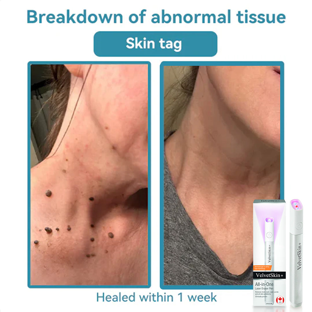 DedMuller®VelvetSkin+ Integrated laser eraser (powered by CO₂ laser technology - effectively removes moles, warts, skin labels, pigmentation spots and other skin defects)