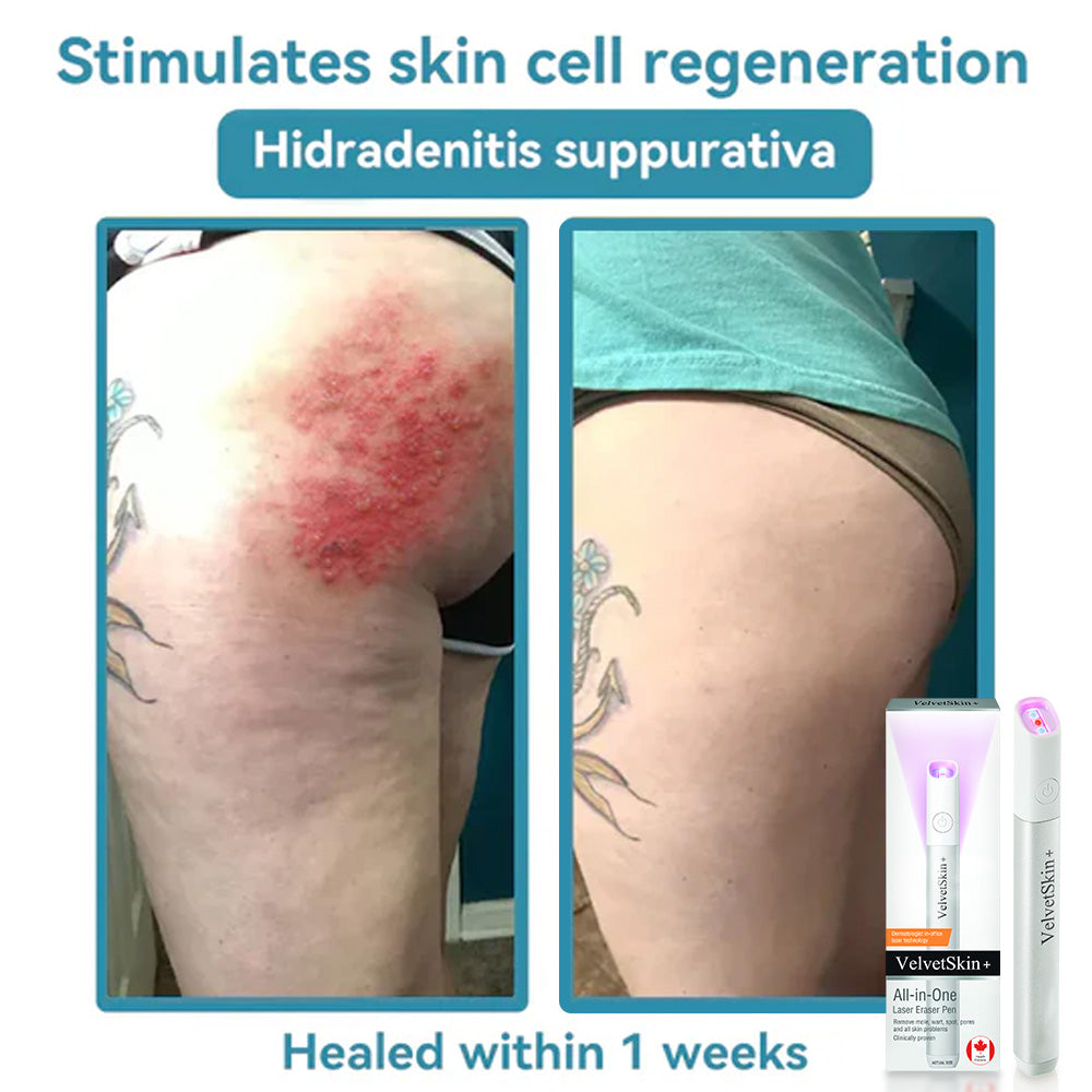 DedMuller®VelvetSkin+ Integrated laser eraser (powered by CO₂ laser technology - effectively removes moles, warts, skin labels, pigmentation spots and other skin defects)