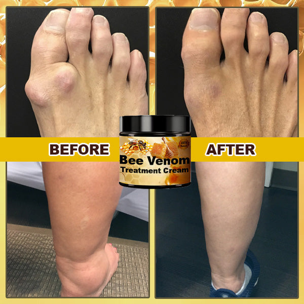 Arthritis Treatment Bee Venom Cream