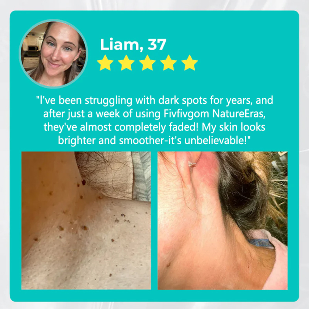 ✅Offizieller Shop: LOVILDS™ NatureErase Instant Alligator Oil Leberfleck- und Fleckenentfernung Plus Gel