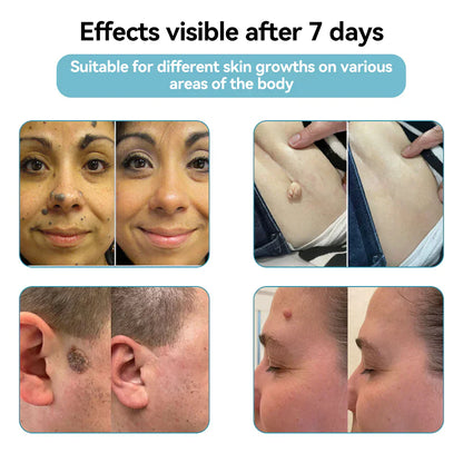 DedMuller®VelvetSkin+ Integrated laser eraser (powered by CO₂ laser technology - effectively removes moles, warts, skin labels, pigmentation spots and other skin defects)