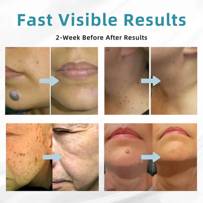 DedMuller®VelvetSkin+ Integrated laser eraser (powered by CO₂ laser technology - effectively removes moles, warts, skin labels, pigmentation spots and other skin defects)