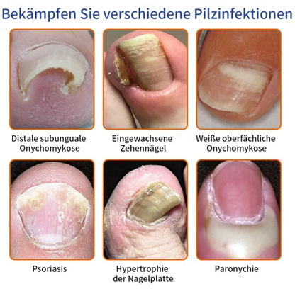 Furzero  Bee Venom Nagelpilz Behandlungsléisung