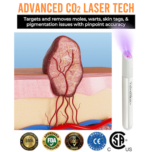 DedMuller®VelvetSkin+ Integrated laser eraser (powered by CO₂ laser technology - effectively removes moles, warts, skin labels, pigmentation spots and other skin defects)