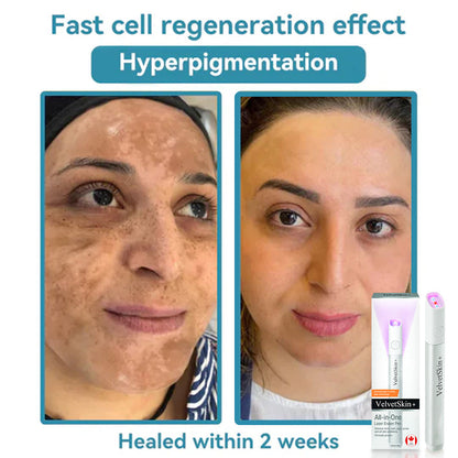DedMuller®VelvetSkin+ Integrated laser eraser (powered by CO₂ laser technology - effectively removes moles, warts, skin labels, pigmentation spots and other skin defects)