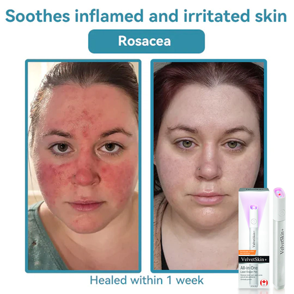 DedMuller®VelvetSkin+ Integrated laser eraser (powered by CO₂ laser technology - effectively removes moles, warts, skin labels, pigmentation spots and other skin defects)